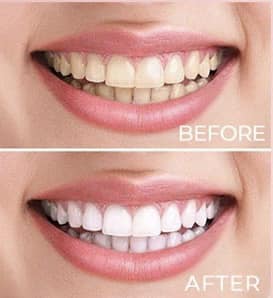 Cosmic SMILE whitening kit